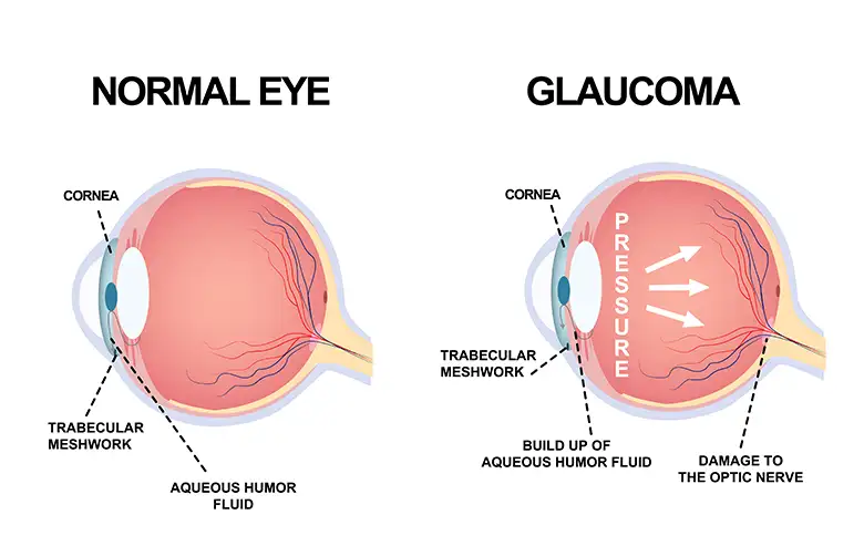 UNDERSTANDING GLAUCOMA